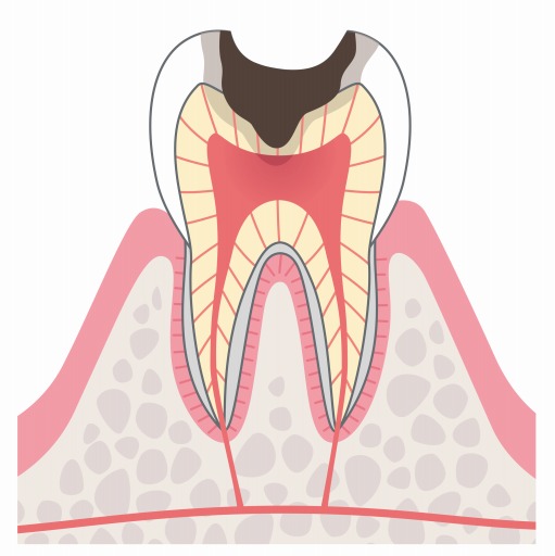 C3：虫歯が神経に到達している