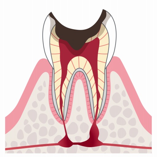 C4：歯根まで到達した虫歯
