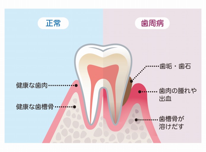 原因や症状に合わせた歯周病治療