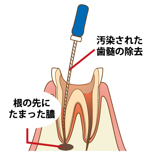 重度に進行した虫歯に行います