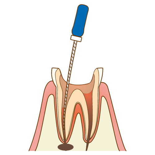 根管内の汚れを取り除きます